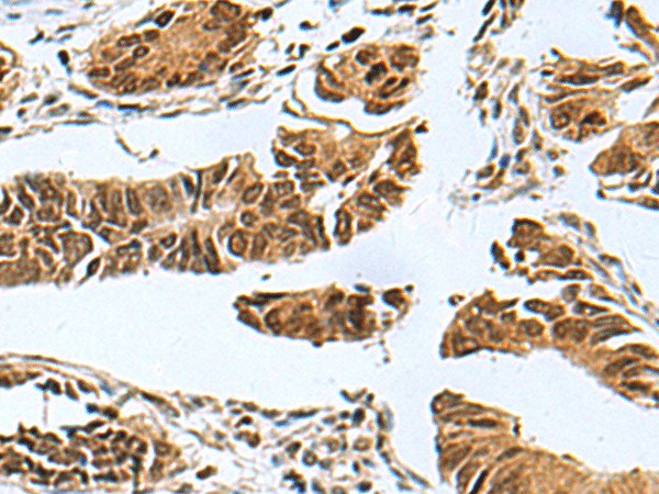 Immunohistochemistry of paraffin-embedded Human colorectal cancer tissue  using PDCD5 Polyclonal Antibody at dilution of 1:55(?200)