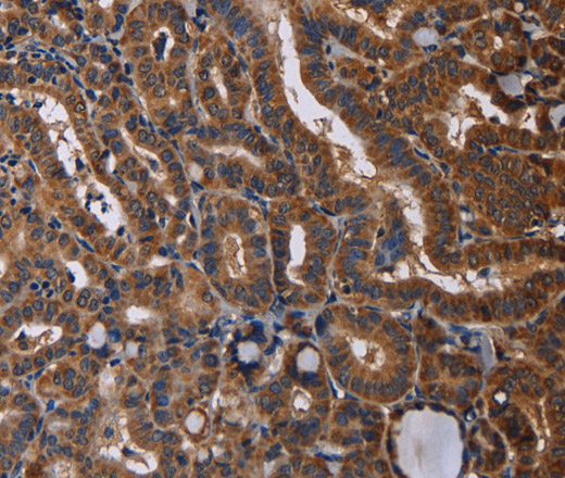 Immunohistochemistry of paraffin-embedded Human thyroid cancer tissue using RTN4R Polyclonal Antibody at dilution 1:50