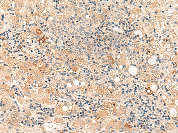 Immunohistochemistry of paraffin-embedded Human liver cancer tissue  using SULT4A1 Polyclonal Antibody at dilution of 1:50(?200)