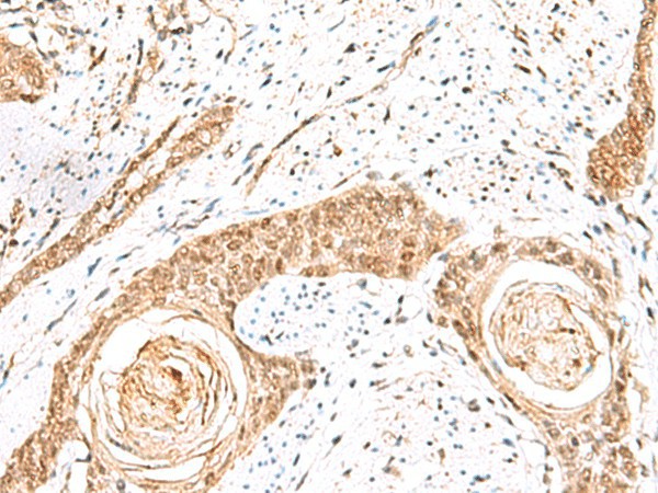 Immunohistochemistry of paraffin-embedded Human esophagus cancer tissue  using ELF3 Polyclonal Antibody at dilution of 1:60(?200)