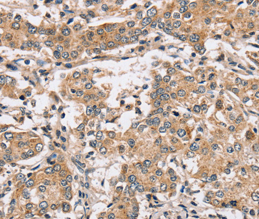 Immunohistochemistry of paraffin-embedded Human liver cancer using PPP1CC Polyclonal Antibody at dilution of 1:40