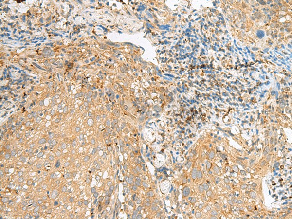 Immunohistochemistry of paraffin-embedded Human cervical cancer tissue  using COPE Polyclonal Antibody at dilution of 1:50(?200)