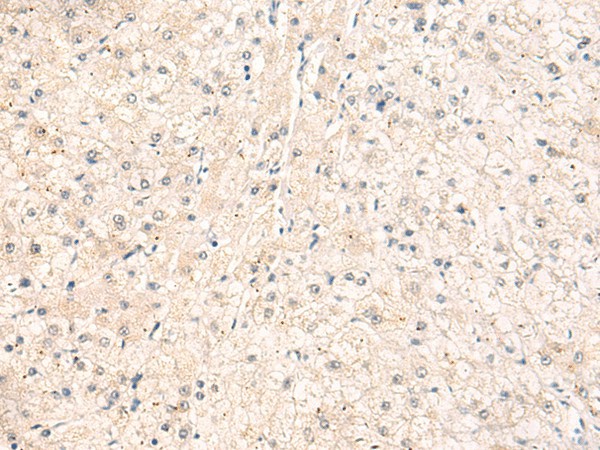 Immunohistochemistry of paraffin-embedded Human liver cancer tissue  using ELP1 Polyclonal Antibody at dilution of 1:30(?200)