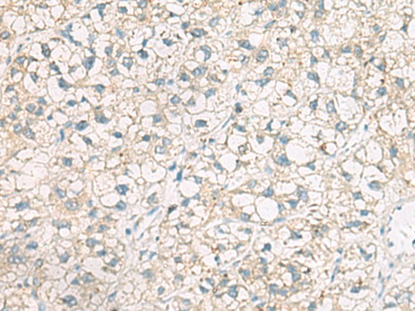 Immunohistochemistry of paraffin-embedded Human liver cancer tissue  using POFUT1 Polyclonal Antibody at dilution of 1:50(?200)