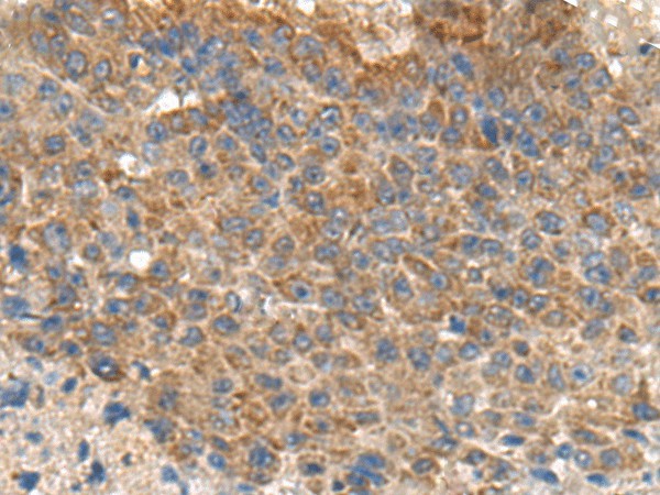 Immunohistochemistry of paraffin-embedded Human liver cancer tissue  using MIA Polyclonal Antibody at dilution of 1:180(?200)