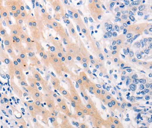 Immunohistochemistry of paraffin-embedded Human lung cancer tissue using MUC2 Polyclonal Antibody at dilution 1:60