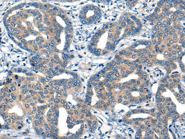 Immunohistochemistry of paraffin-embedded Human liver cancer tissue  using MIIP Polyclonal Antibody at dilution of 1:45(?200)