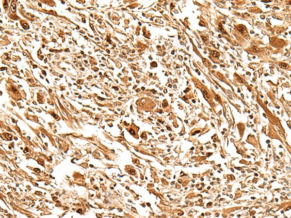 Immunohistochemistry of paraffin-embedded Human liver cancer tissue  using FIZ1 Polyclonal Antibody at dilution of 1:35(?200)