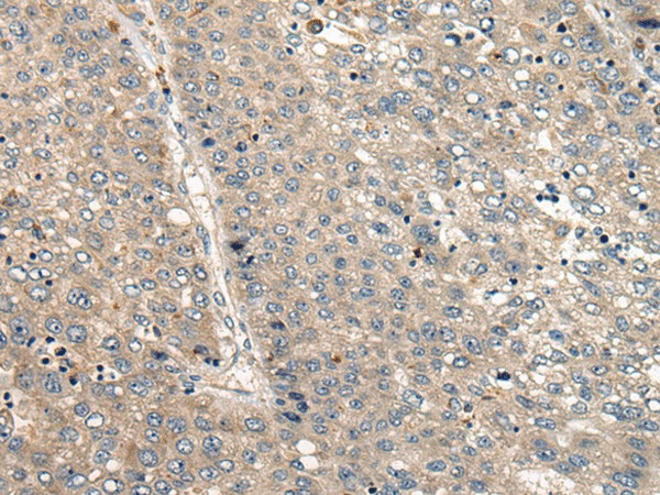 Immunohistochemistry of paraffin-embedded Human liver cancer tissue  using CC2D1A Polyclonal Antibody at dilution of 1:35(?200)