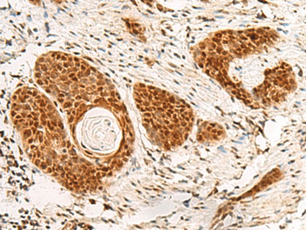 Immunohistochemistry of paraffin-embedded Human esophagus cancer tissue  using POM121 Polyclonal Antibody at dilution of 1:75(?200)