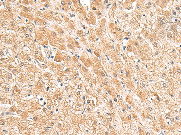 Immunohistochemistry of paraffin-embedded Human liver cancer tissue  using TRUB1 Polyclonal Antibody at dilution of 1:85(?200)