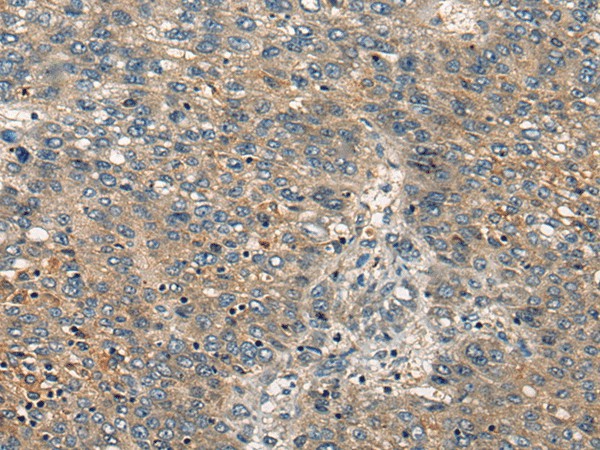 Immunohistochemistry of paraffin-embedded Human liver cancer tissue  using CDKL2 Polyclonal Antibody at dilution of 1:25(?200)