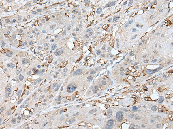 Immunohistochemistry of paraffin-embedded Human esophagus cancer tissue  using CD14 Polyclonal Antibody at dilution of 1:40(?200)