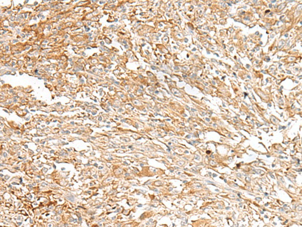 Immunohistochemistry of paraffin-embedded Human liver cancer tissue  using IBSP Polyclonal Antibody at dilution of 1:30(?200)