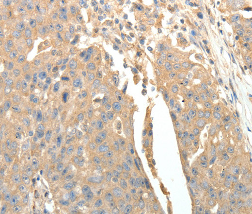 Immunohistochemistry of paraffin-embedded Human ovarian cancer tissue using SFTPD Polyclonal Antibody at dilution 1:30