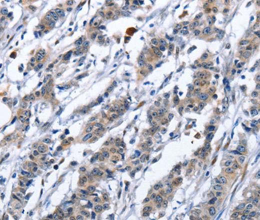 Immunohistochemistry of paraffin-embedded Human cervical cancer tissue using CD137 Polyclonal Antibody at dilution 1:50