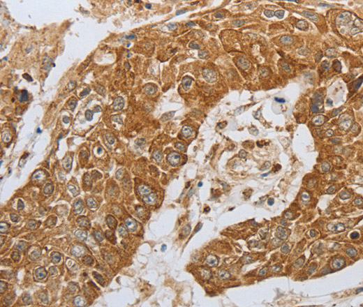 Immunohistochemistry of paraffin-embedded Human esophagus cancer using CKM Polyclonal Antibody at dilution of 1:50