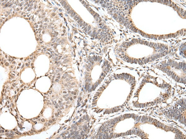 Immunohistochemistry of paraffin-embedded Human gastric cancer tissue  using ZNF281 Polyclonal Antibody at dilution of 1:30(?200)