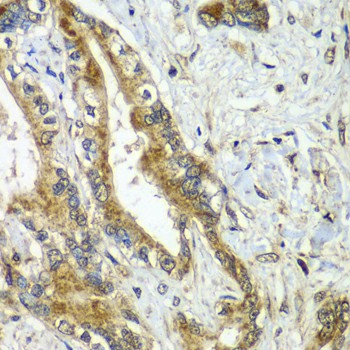 Immunohistochemistry of paraffin-embedded human liver cancer using CDC16 Polyclonal Antibody at dilution of 1:100 (40x lens).Perform microwave antigen retrieval with 10 mM PBS buffer pH 7.2 before commencing with IHC staining protocol.