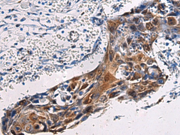 Immunohistochemistry of paraffin-embedded Human esophagus cancer tissue  using SORD Polyclonal Antibody at dilution of 1:45(?200)