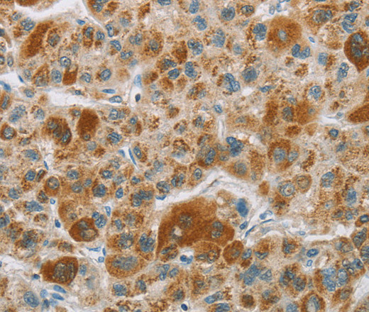 Immunohistochemistry of paraffin-embedded Human liver cancer tissue using CYP27A1 Polyclonal Antibody at dilution 1:50