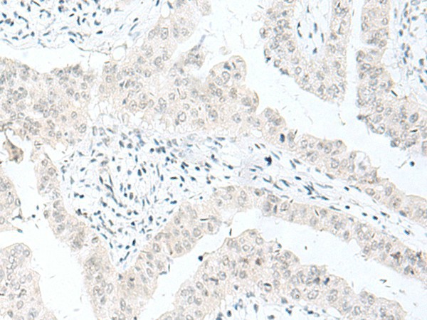 Immunohistochemistry of paraffin-embedded Human liver cancer tissue  using ENSA Polyclonal Antibody at dilution of 1:70(?200)