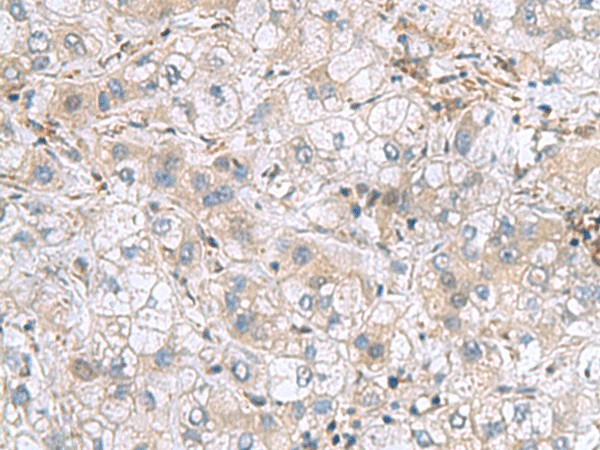 Immunohistochemistry of paraffin-embedded Human liver cancer tissue  using TXNDC12 Polyclonal Antibody at dilution of 1:70(?200)