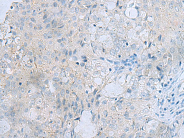 Immunohistochemistry of paraffin-embedded Human ovarian cancer tissue  using MSI2 Polyclonal Antibody at dilution of 1:70(?200)