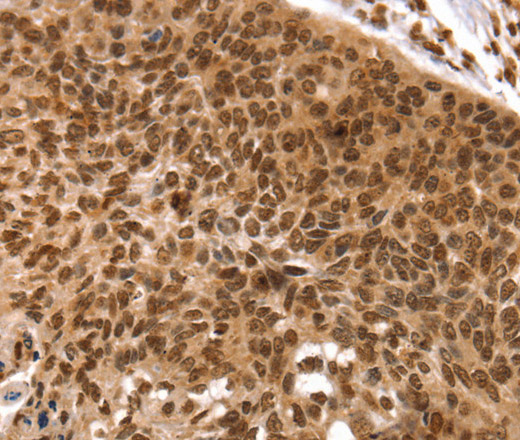 Immunohistochemistry of paraffin-embedded Human esophagus cancer using TAF10 Polyclonal Antibody at dilution of 1:35