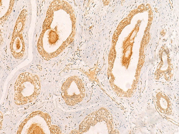 Immunohistochemistry of paraffin-embedded Human breast cancer tissue  using ZNF580 Polyclonal Antibody at dilution of 1:40(?200)