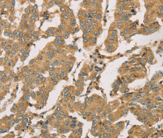 Immunohistochemistry of paraffin-embedded Human breast cancer using DMRT3 Polyclonal Antibody at dilution of 1:50