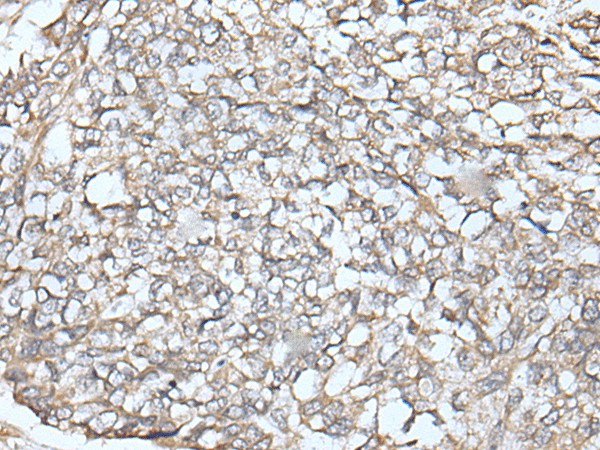 Immunohistochemistry of paraffin-embedded Human lung cancer tissue  using IFNB1 Polyclonal Antibody at dilution of 1:45(?200)