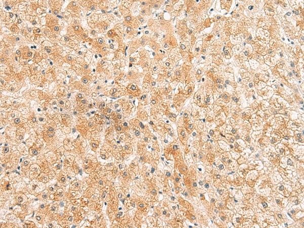 Immunohistochemistry of paraffin-embedded Human liver cancer tissue  using ZNF185 Polyclonal Antibody at dilution of 1:25(?200)