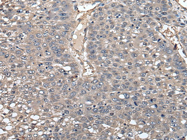 Immunohistochemistry of paraffin-embedded Human liver cancer tissue  using GCNT2 Polyclonal Antibody at dilution of 1:55(?200)