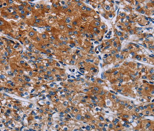 Immunohistochemistry of paraffin-embedded Human prostate cancer using HYAL3 Polyclonal Antibody at dilution of 1:40