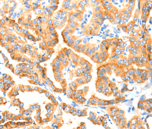 Immunohistochemistry of paraffin-embedded Human thyroid cancer tissue using MANF Polyclonal Antibody at dilution 1:70