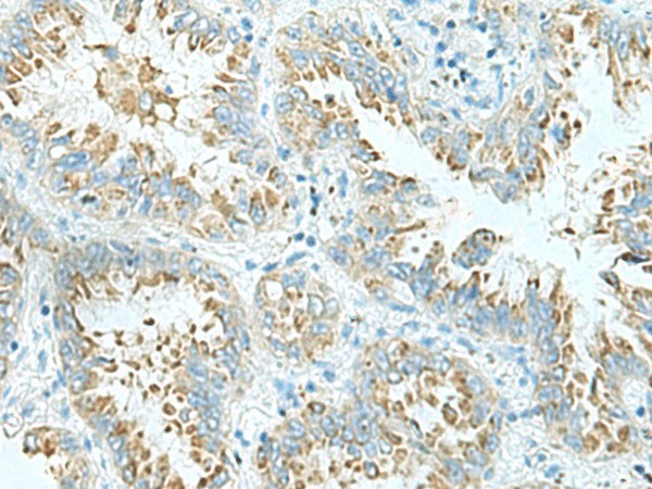 Immunohistochemistry of paraffin-embedded Human lung cancer tissue  using SHTN1 Polyclonal Antibody at dilution of 1:30(?200)