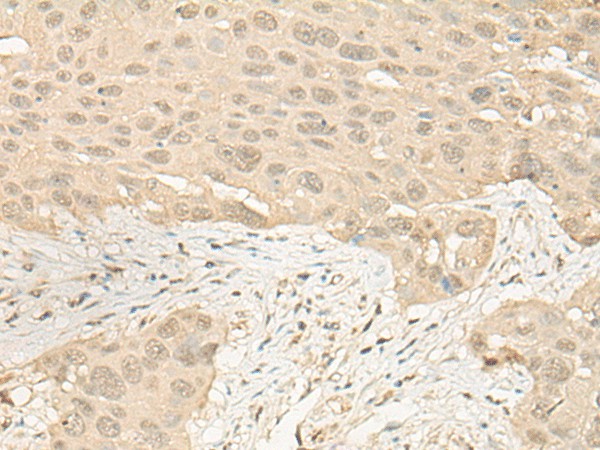 Immunohistochemistry of paraffin-embedded Human esophagus cancer tissue  using IMPA1 Polyclonal Antibody at dilution of 1:25(?200)