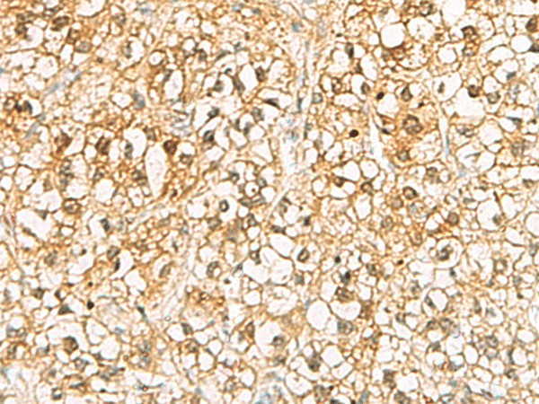 Immunohistochemistry of paraffin-embedded Human liver cancer tissue  using C11orf54 Polyclonal Antibody at dilution of 1:70(?200)