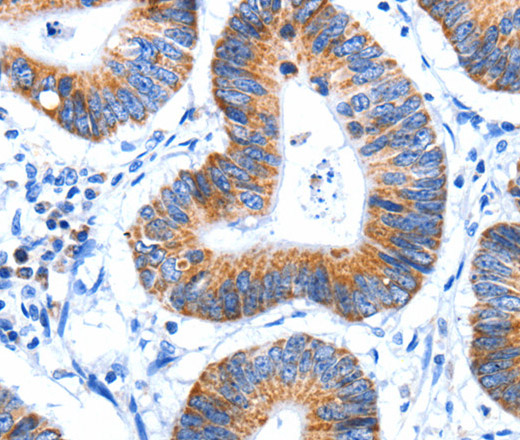 Immunohistochemistry of paraffin-embedded Human colon cancer tissue using HINT2 Polyclonal Antibody at dilution 1:60