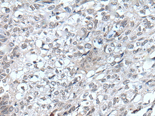 Immunohistochemistry of paraffin-embedded Human lung cancer tissue  using FLT4 Polyclonal Antibody at dilution of 1:40(?200)