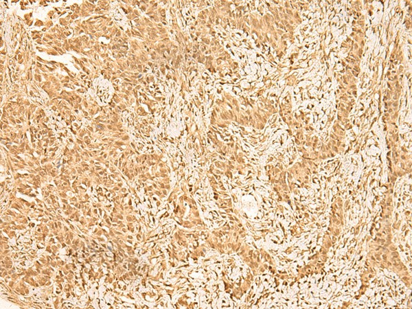 Immunohistochemistry of paraffin-embedded Human ovarian cancer tissue  using ZNF471 Polyclonal Antibody at dilution of 1:50(?200)