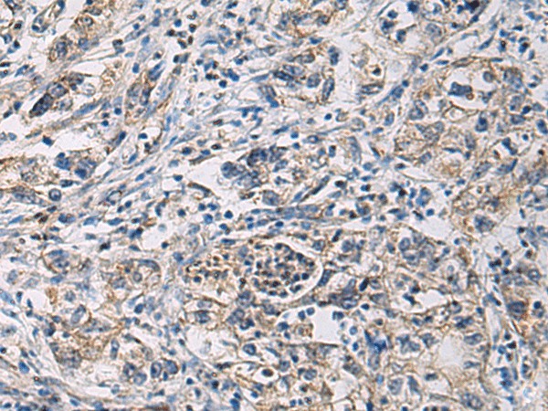 Immunohistochemistry of paraffin-embedded Human gastric cancer tissue  using CYTIP Polyclonal Antibody at dilution of 1:100(?200)