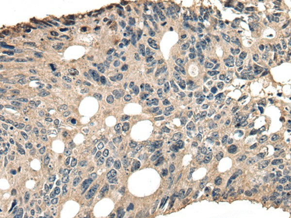 Immunohistochemistry of paraffin-embedded Human colorectal cancer tissue  using SLAMF7 Polyclonal Antibody at dilution of 1:30(?200)