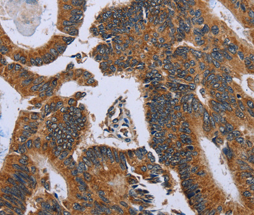 Immunohistochemistry of paraffin-embedded Human colon cancer using GH2 Polyclonal Antibody at dilution of 1:60