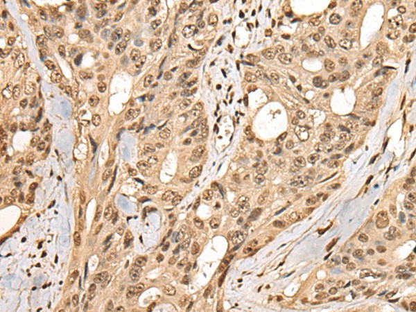 Immunohistochemistry of paraffin-embedded Human colorectal cancer tissue  using PHF21A Polyclonal Antibody at dilution of 1:50(?200)