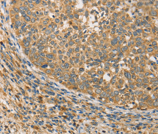 Immunohistochemistry of paraffin-embedded Human cervical cancer tissue using ATG3 Polyclonal Antibody at dilution 1:40