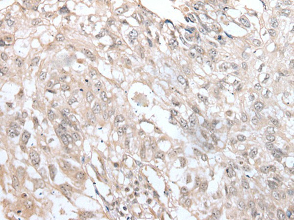 Immunohistochemistry of paraffin-embedded Human lung cancer tissue  using VRK3 Polyclonal Antibody at dilution of 1:45(?200)