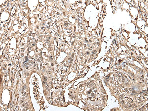 Immunohistochemistry of paraffin-embedded Human colorectal cancer tissue  using UTP3 Polyclonal Antibody at dilution of 1:40(?200)