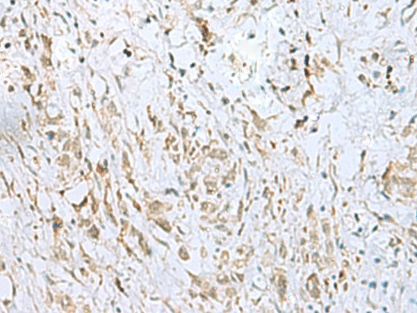 Immunohistochemistry of paraffin-embedded Human gastric cancer tissue  using ECT2 Polyclonal Antibody at dilution of 1:35(?200)